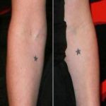Stelle sull'avambraccio