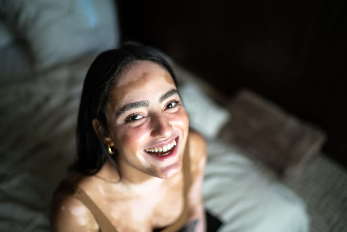 ragazza con vitiligine